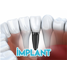 implant